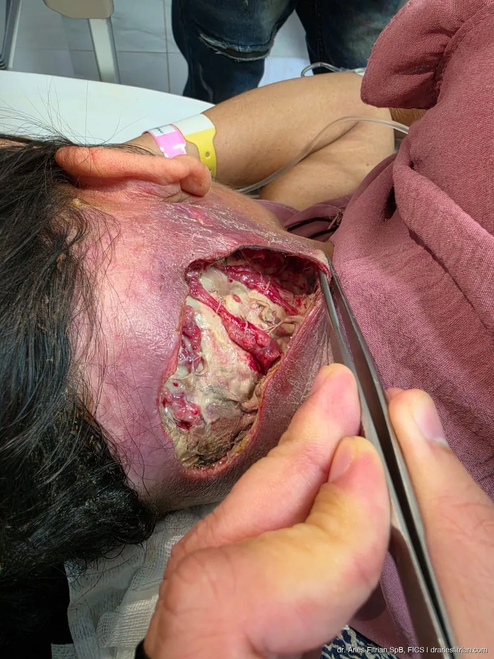 Debridement