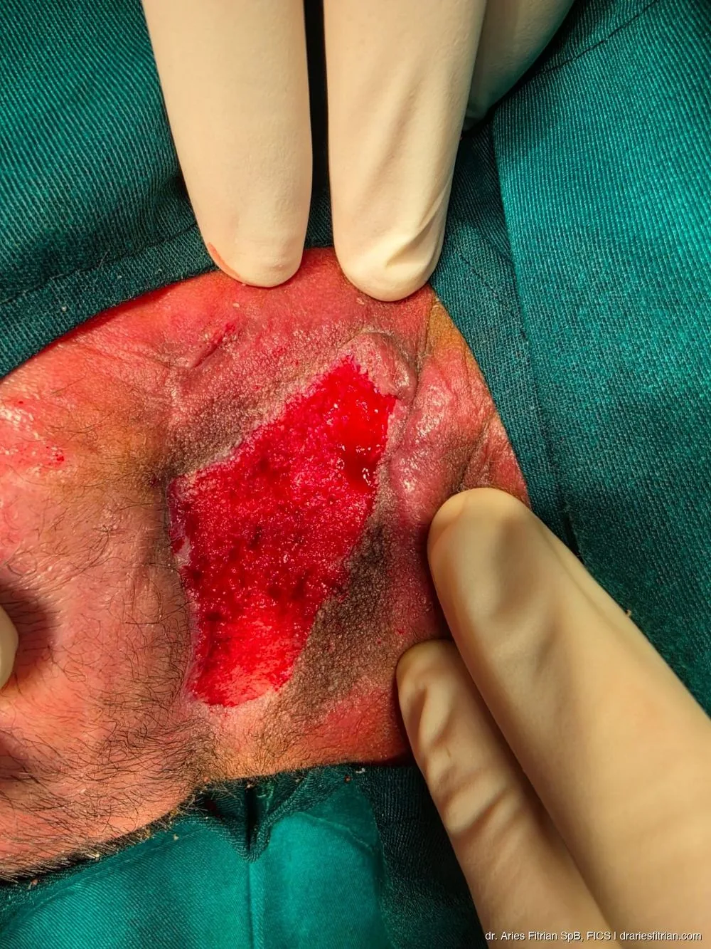 Intraop STSG