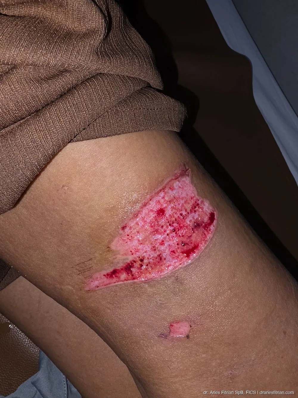 Donor site paha