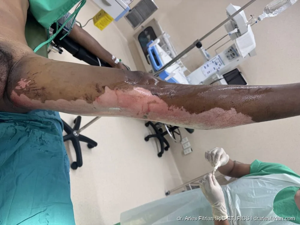 Persiapan debridement awal