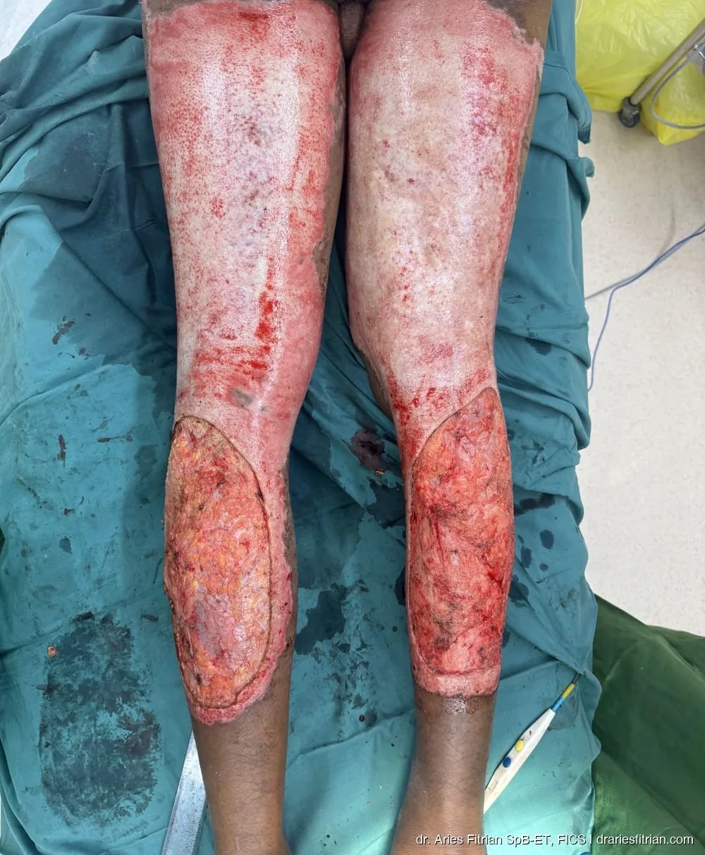 Tampak belakang — full-thickness burn bilateral tungkai (pre-operasi)