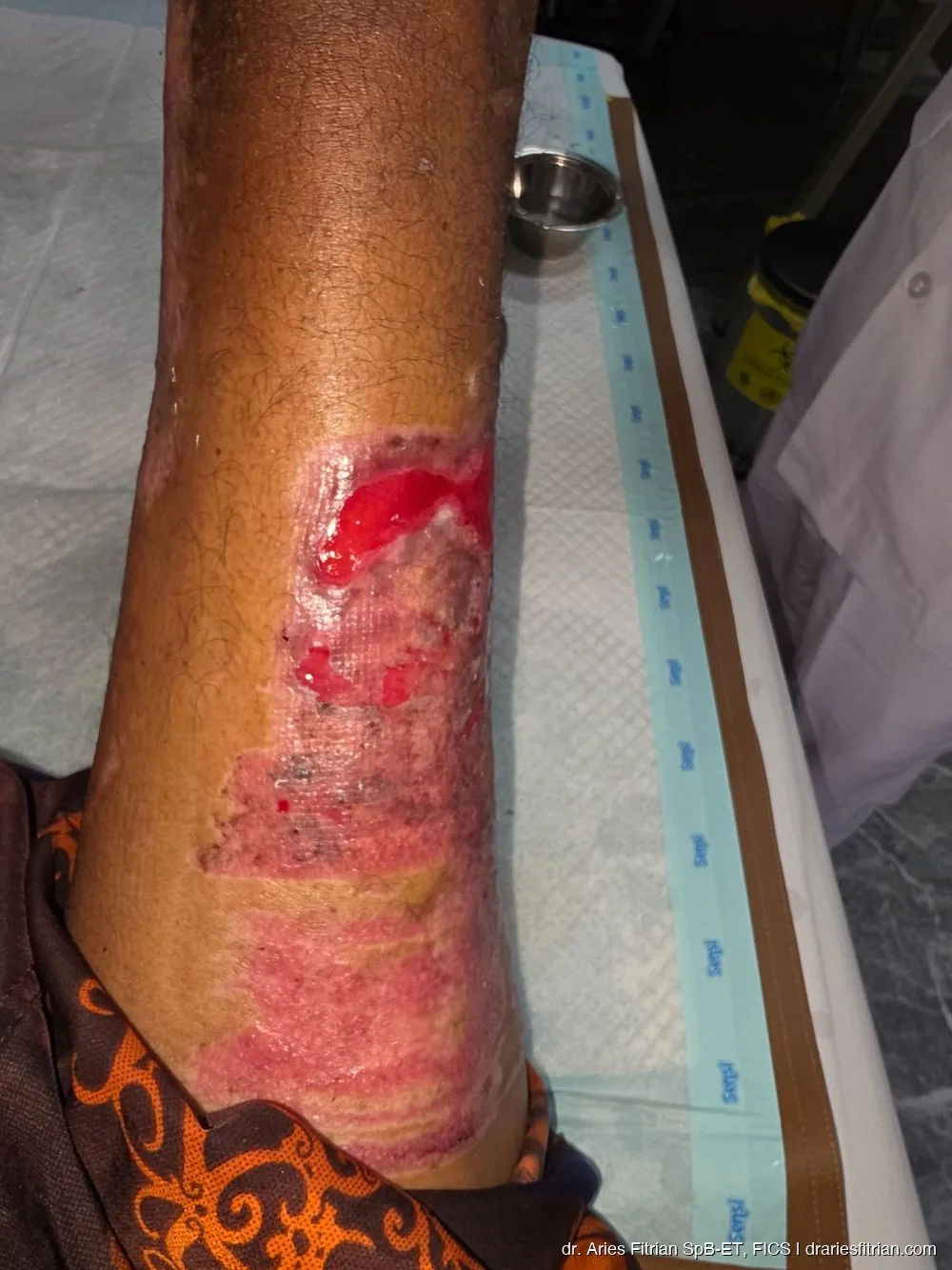 Kondisi luka selama proses debridement & VAC therapy