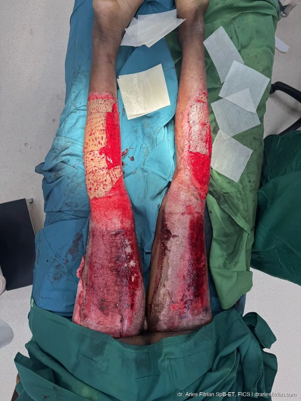 Intraoperatif — pemasangan skin graft pada kedua tungkai
