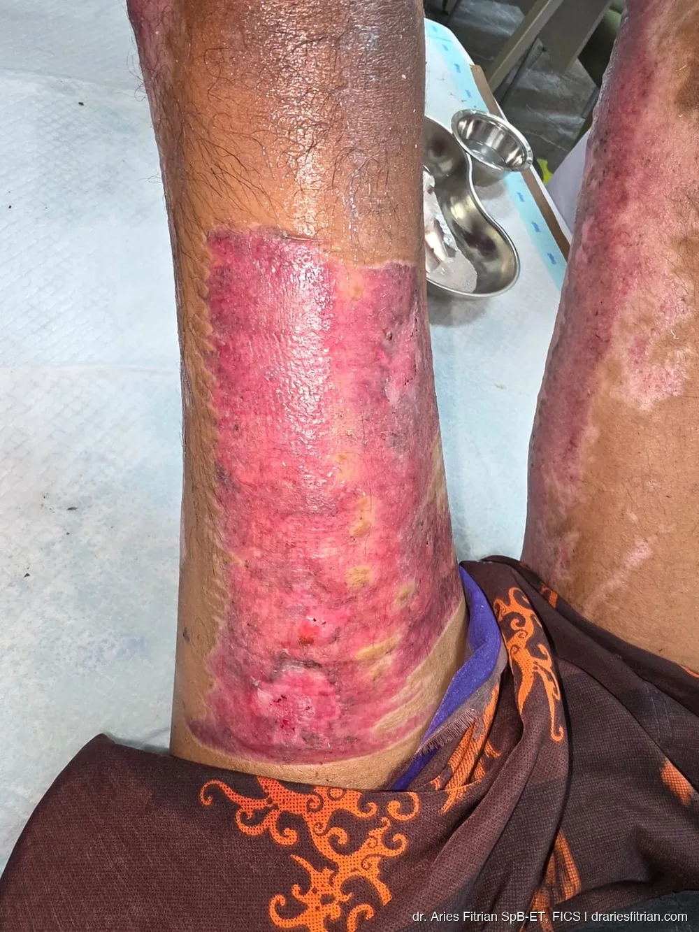 Penyembuhan graft — tampak dekat