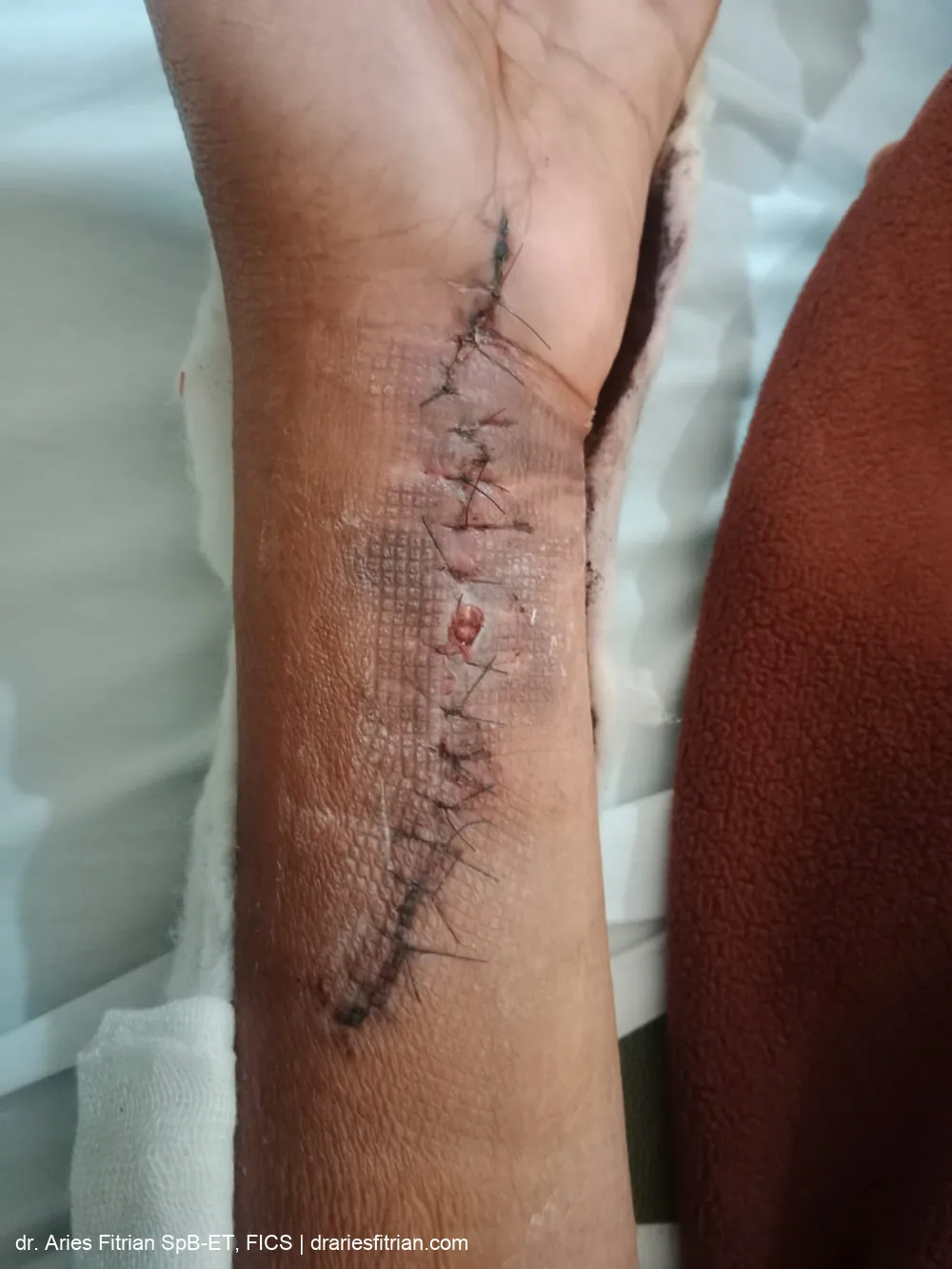 Kondisi luka setelah terapi PICO 7 — jaringan membaik