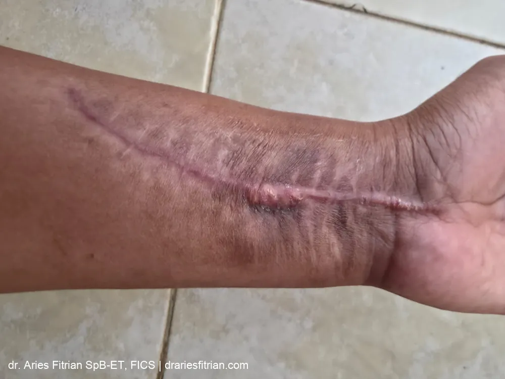 Hasil akhir — bekas luka reanastomosis arteri radialis yang telah matang dan memudar