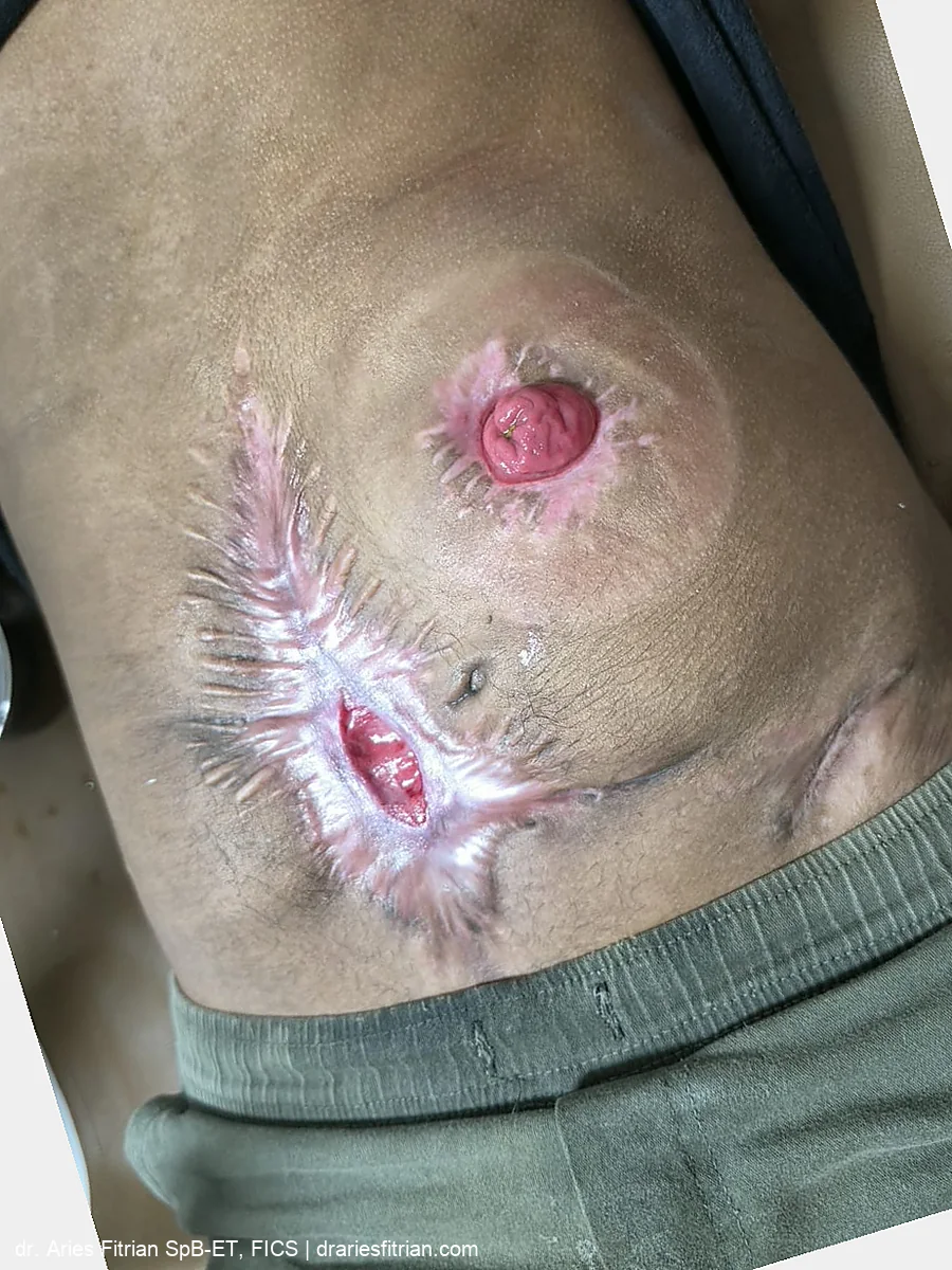 Kondisi pemulihan — perut sebagian besar sembuh, menyisakan luka kecil; stoma terpasang