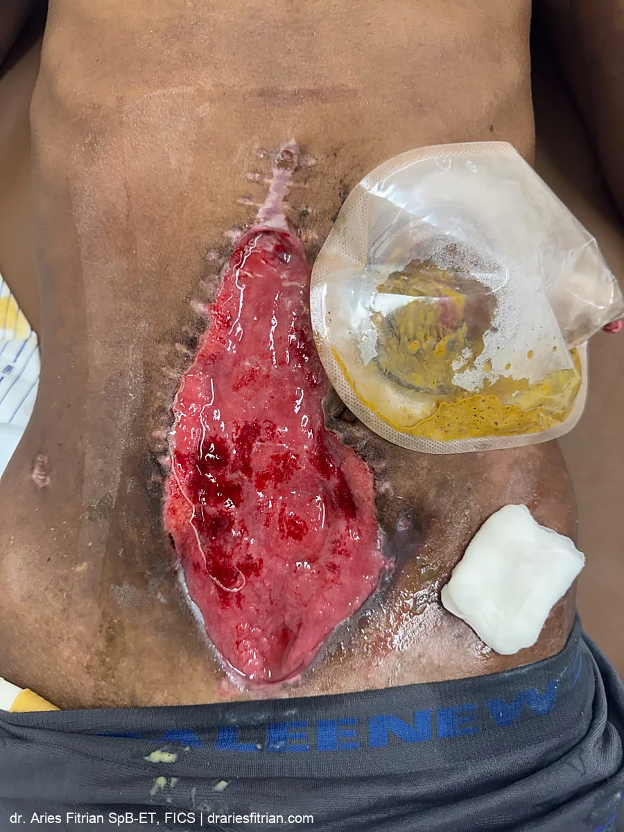 Luka terbuka luas selama perawatan, dengan manajemen keluaran fistula
