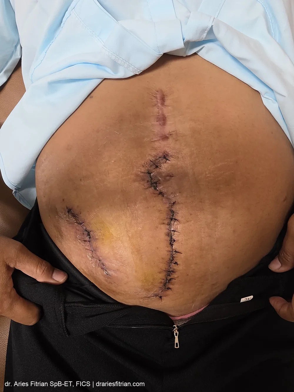 Kondisi pascaoperasi — insisi midline dan insisi lateral telah terjahit, dinyatakan sembuh baik